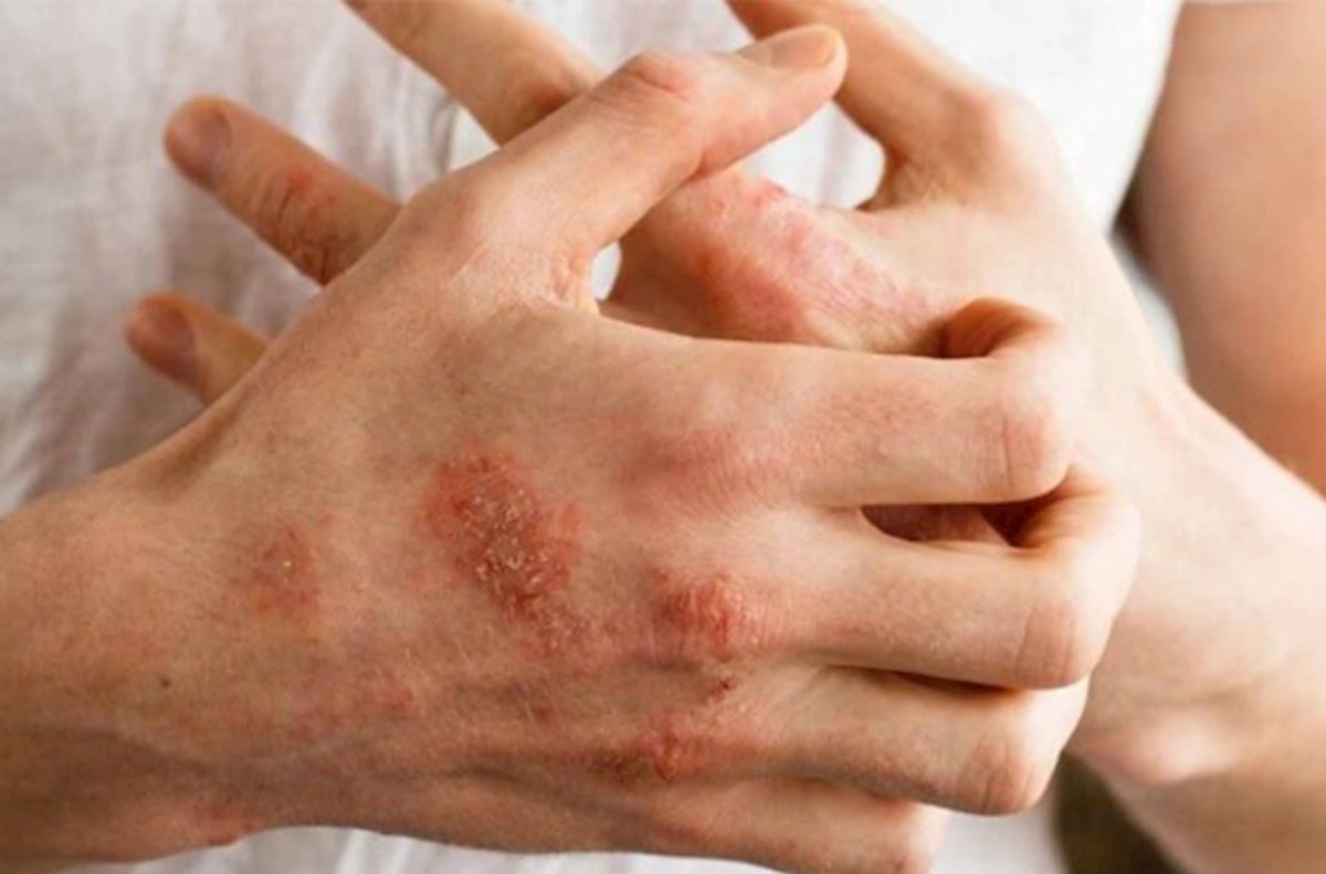 The number of scabies in Azerbaijan has increased fivefold – Top Buzz Times